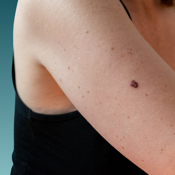 Hautkrebsscreening, California Skin Ingolstadt